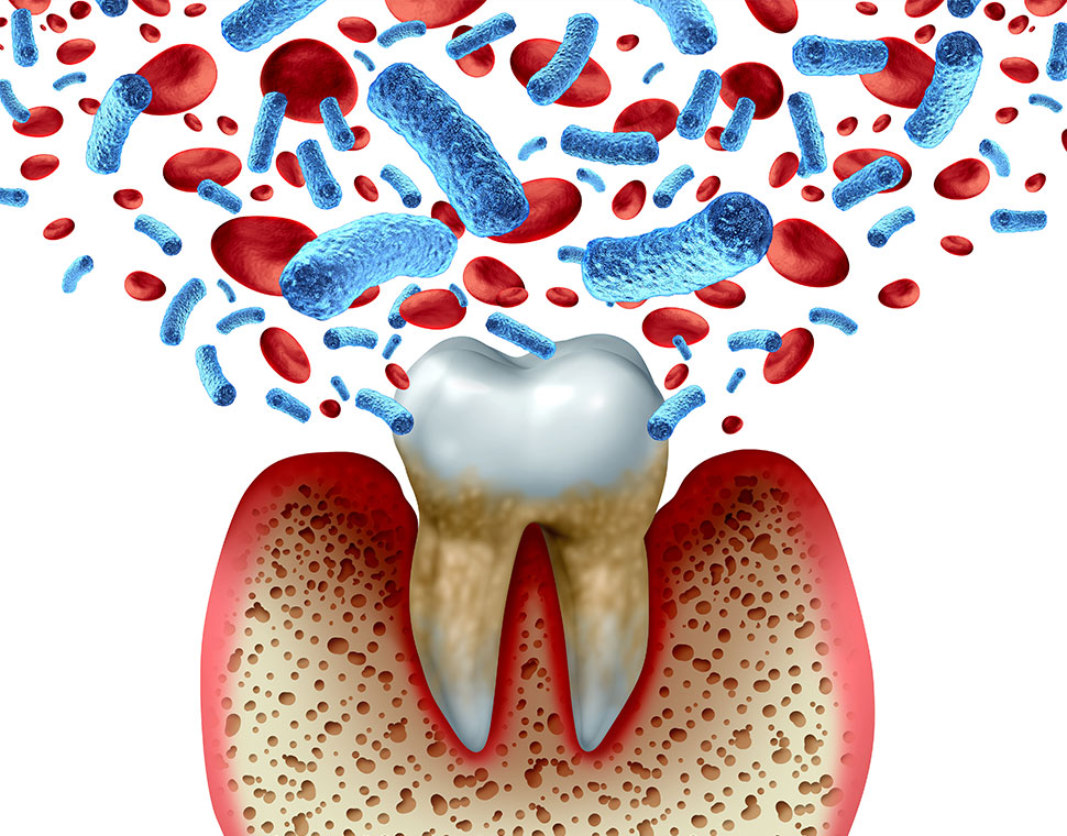 矯正治療の前の虫歯・歯周病治療について
